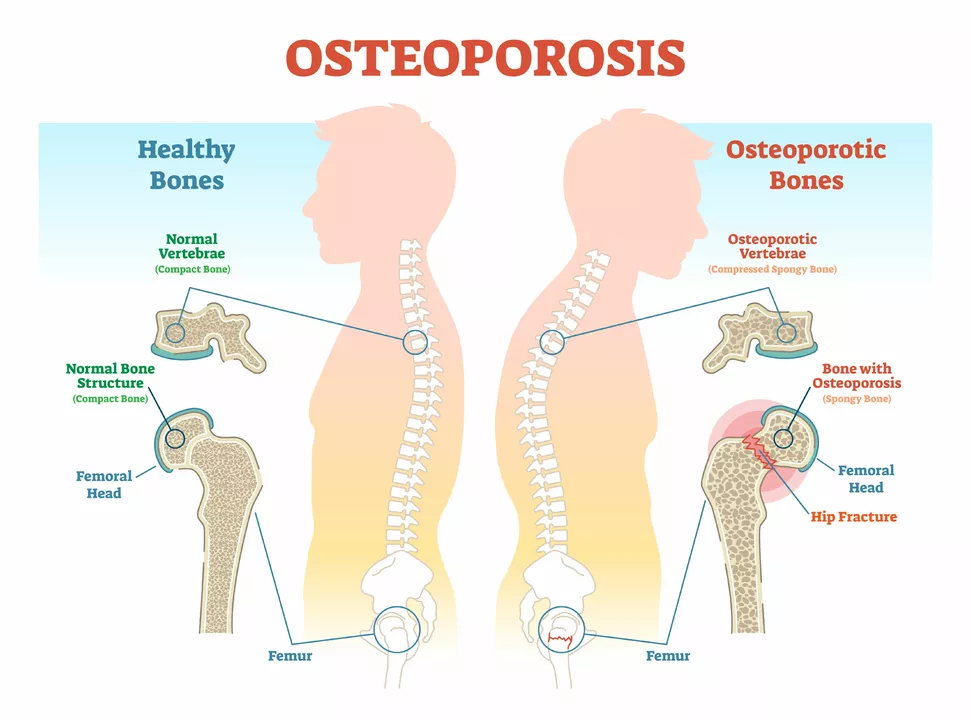 The Connection Between Secondary Hyperparathyroidism and Osteoporosis