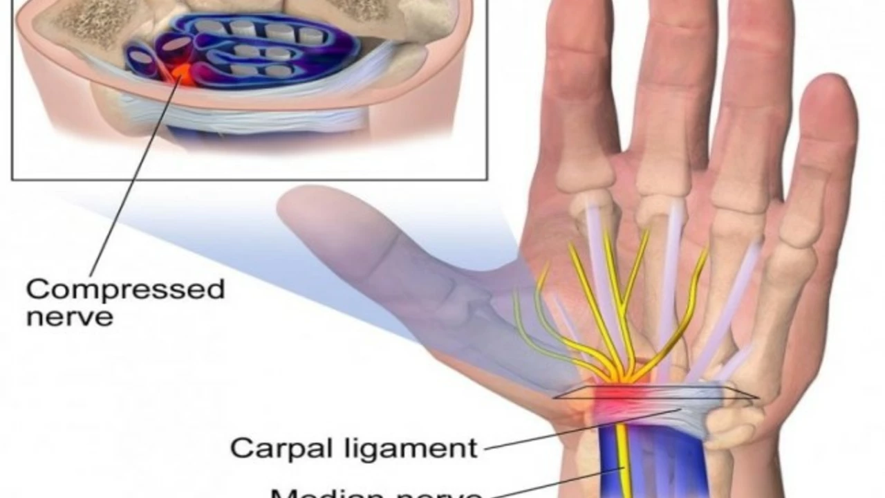 The Connection between Acromegaly and Carpal Tunnel Syndrome
